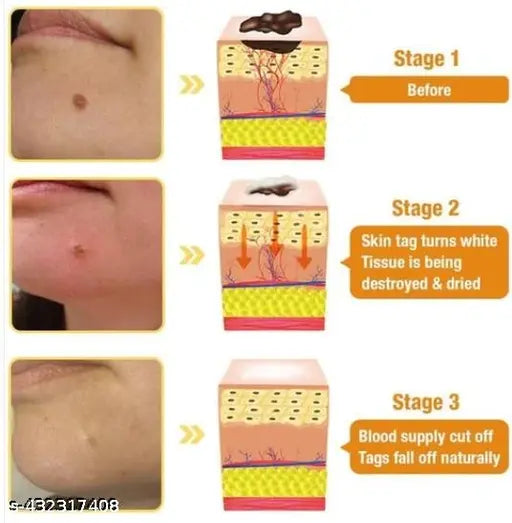 DermaSmooth Skin Tag Remover Patch โ Fast, Safe & Painless Solution